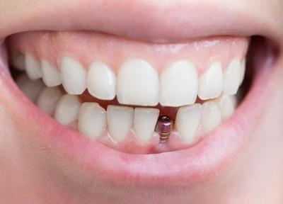 مزیت های ایمپلنت دندان