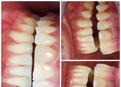 درمانی بی ضرر برای دندان ها